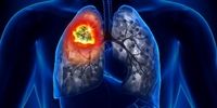 نشانه‌های ابتلا به سرطان ریه را بشناسید