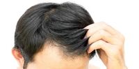آیا قرص رویش مجدد مو موثر است؟