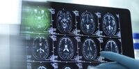 این ماده غذایی سالم باعث آلزایمر می شود!