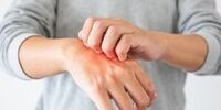 خارش پوست علامت ابتلا به این بیماری های خطرناک است