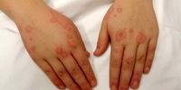  نگاهی به بیماری لاعلاج «سلنا گومز»/ بیماری‌ای که اغلب دامن‌گیر زنان است