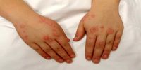  نگاهی به بیماری لاعلاج «سلنا گومز»/ بیماری‌ای که اغلب دامن‌گیر زنان است