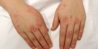  نگاهی به بیماری لاعلاج «سلنا گومز»/ بیماری‌ای که اغلب دامن‌گیر زنان است
