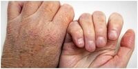 شیوع یک بیماری خطرناک در کشور/ ۲ هزار و ۵۰۳ بیمار جان باختند